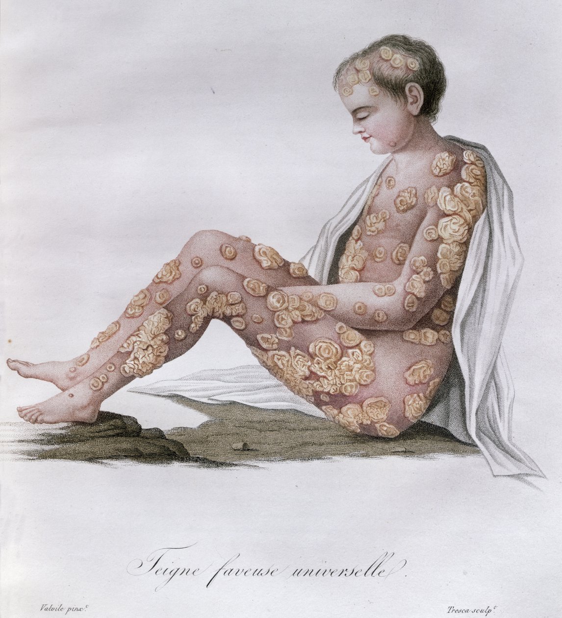 Micose, de um livro do barão Jean Louis Alibert (1768-1837) 1838 de French School