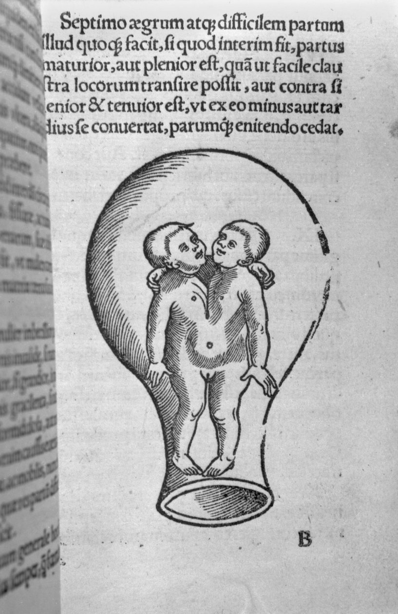 Crianças siamesas, ilustração do chamado manuscrito de Rhodion de French School