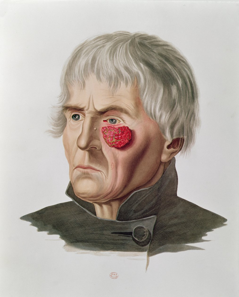 Doença de pele antes de uma operação, de Selecta Praxis Medico-Chirurgica por Alexander Auvert, Paris, 1856 de French School