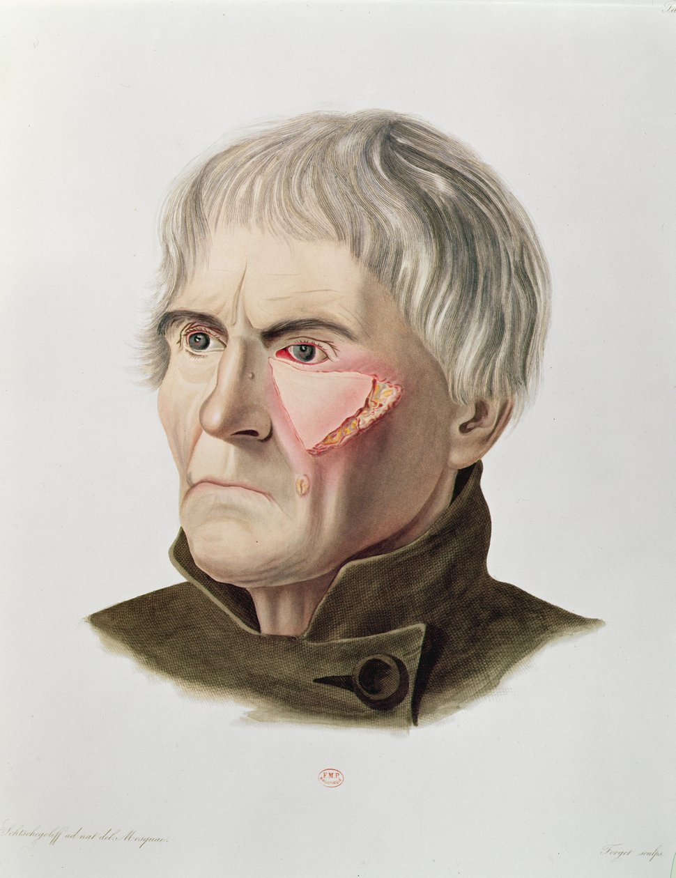 Operação de enxerto de pele, da Selecta Praxis Medico-Chirurgica por Alexander Auvert, Paris, 1856 de French School