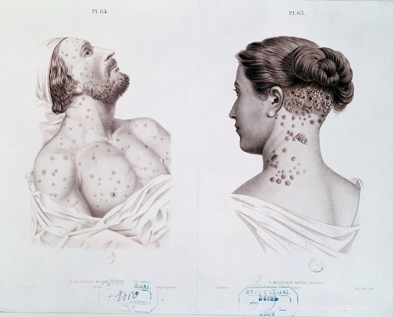 Sintomas da sífilis em homens e mulheres, de um livro médico, c.1850-60 de French School