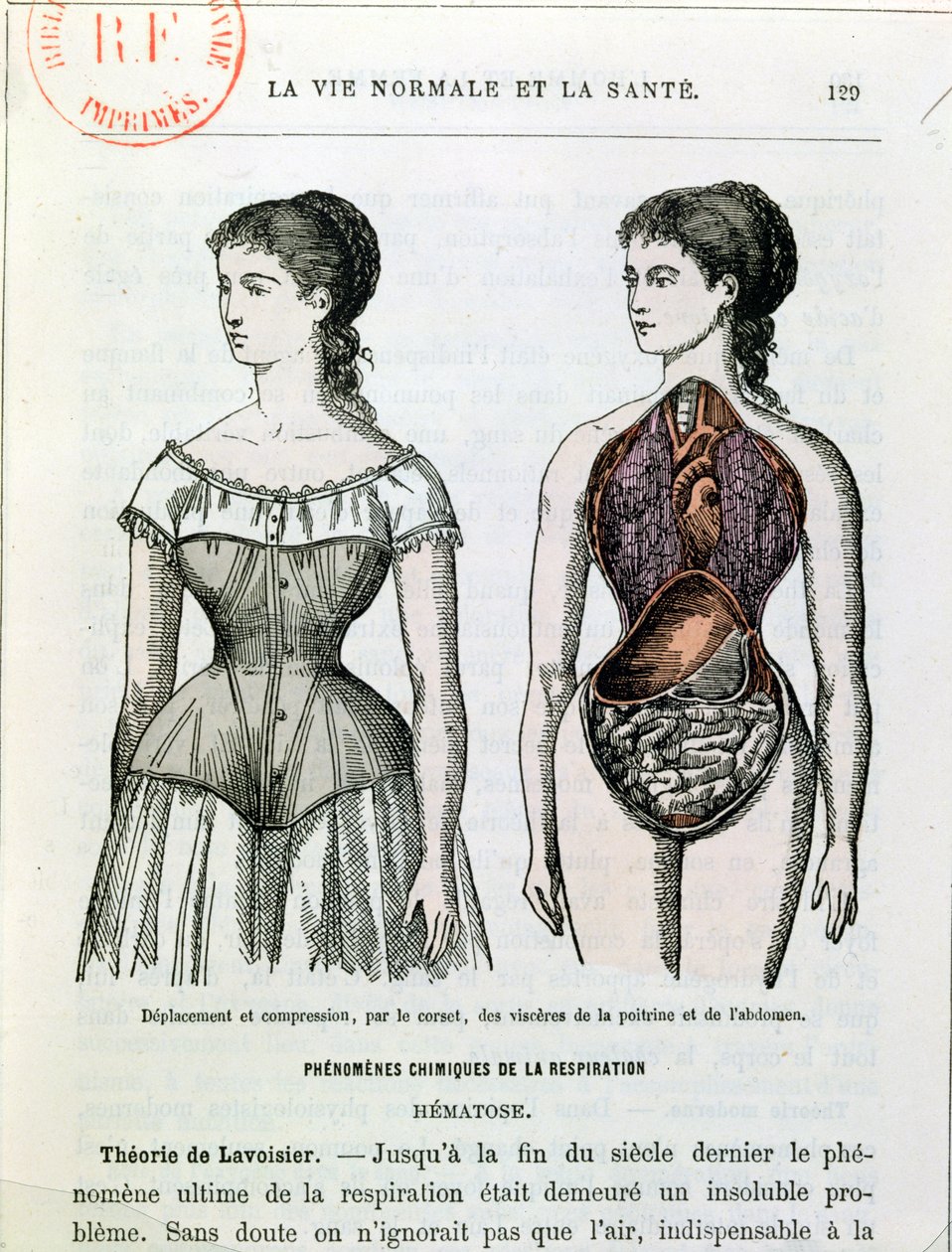 Os efeitos nocivos do espartilho, ilustração de La Vie Normale et la Sante pelo Dr. Jules Rengade (n.1841) c.1880 de French School