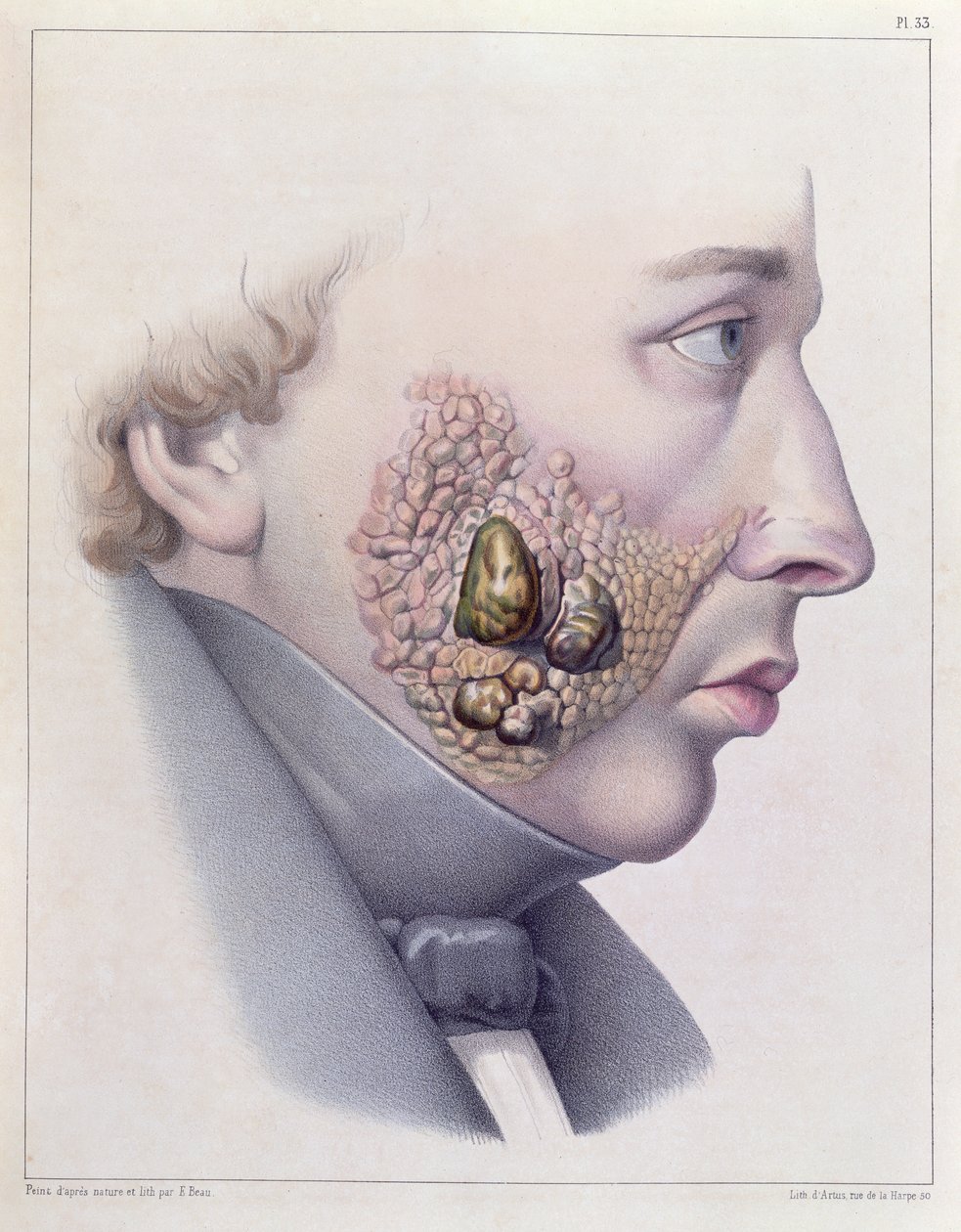 Os sintomas faciais da doença venérea, de Traite Complet des Maladies Veneriennes, de Philippe Ricord (1800-89) 1851 de French School