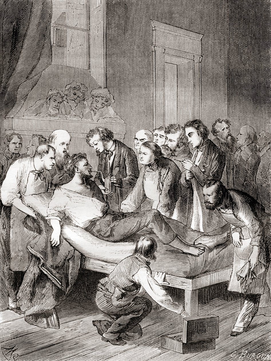 A primeira demonstração pública do uso de éter inalado como anestésico cirúrgico em 1846 por um dentista americano, William Thomas Green Morton, de 