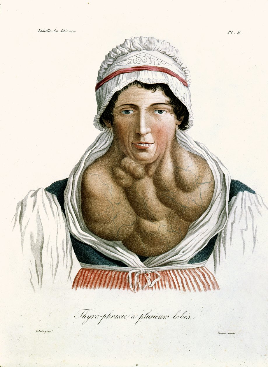 Doença da tireoide, de um livro do barão Jean Louis Alibert (1768-1837) 1817 de French School