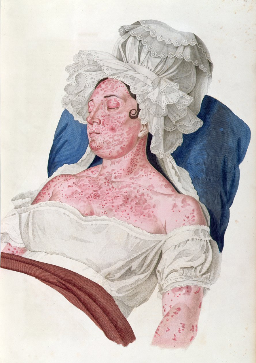 Mulher com escarlatina, de um livro do barão Jean Louis Alibert (1768-1837) gravado por Choupard, 1833 de French School