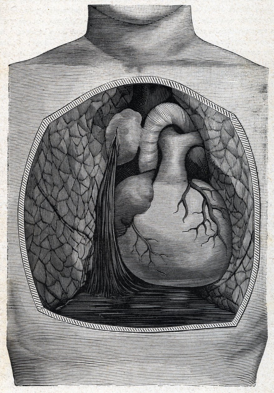 ruptura do aneurisma (gravura) 1888 de French School