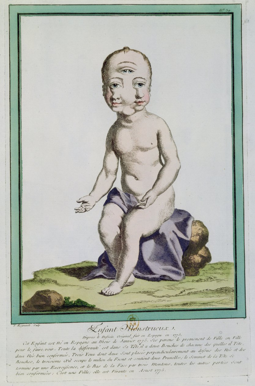 Criança com uma cabeça deformada, de &39;Les Ecarts de la Nature&39;, Paris, 1775 de Genevieve Regnault de Nangis