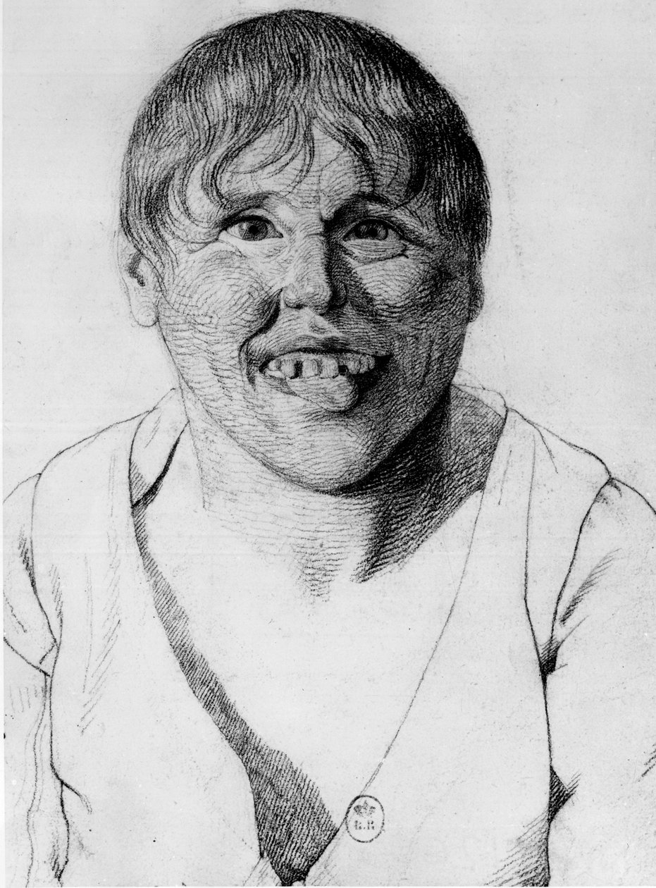 Cretine, -in "Etude de la physionomie des alienes", desenho de Gabriel de Georges Francois Gabriel