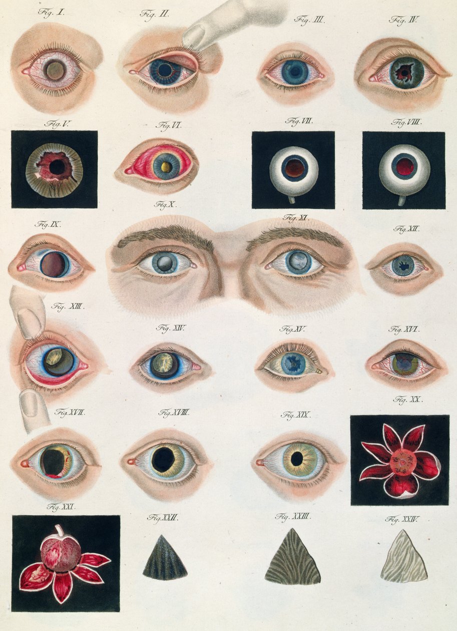 Descrição das anomalias congênitas dos olhos, de Representações Clínicas de Doenças e Erros Cegantes do Olho Mesnschlichen, de Friedrich August von Ammon (1799-1861) 1838 de German School