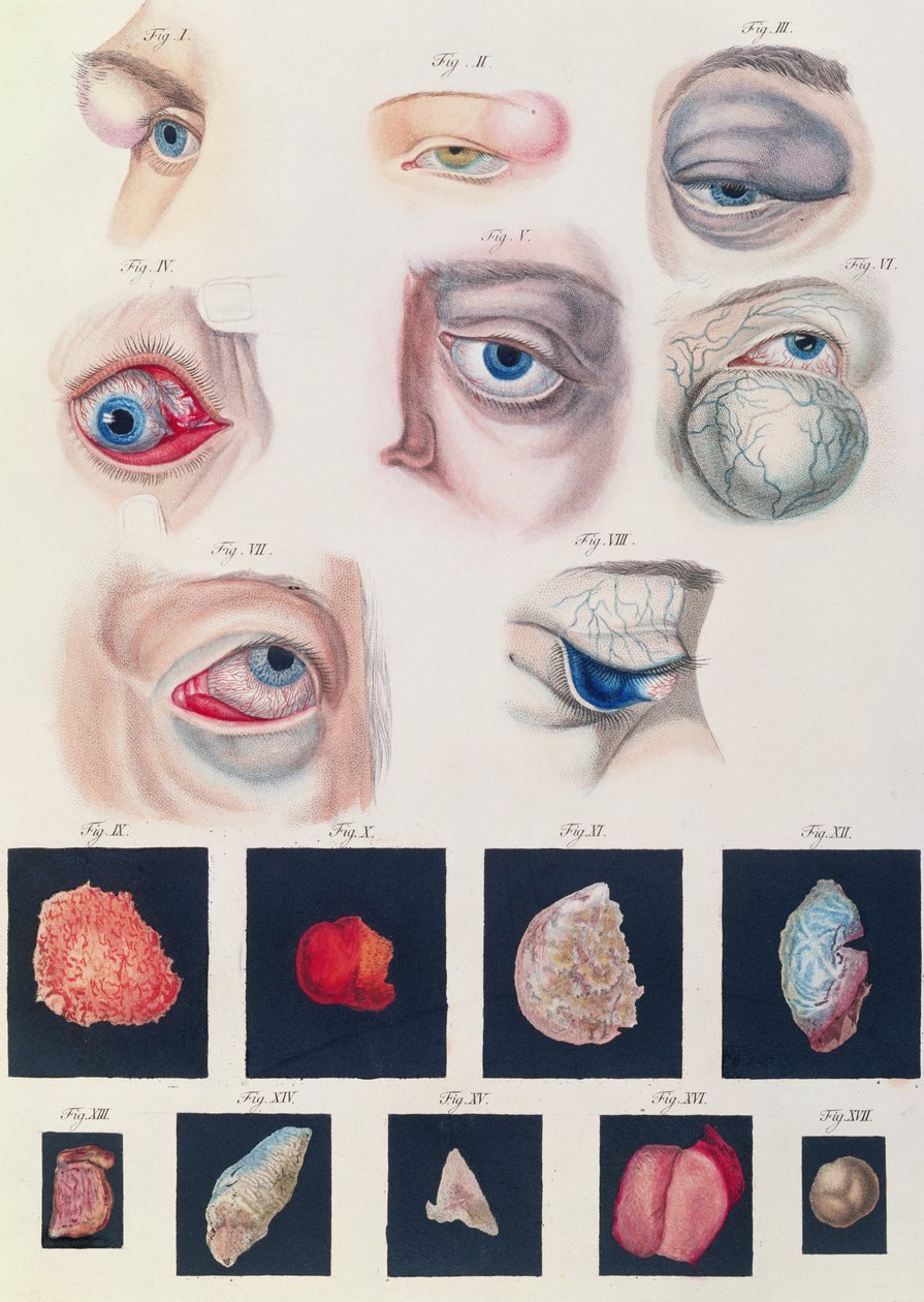 Descrição das anomalias congênitas dos olhos, de Representações Clínicas de Doenças e Erros Cegantes do Olho Mesnschlichen, de Friedrich August von Ammon (1799-1861) 1838 de German School