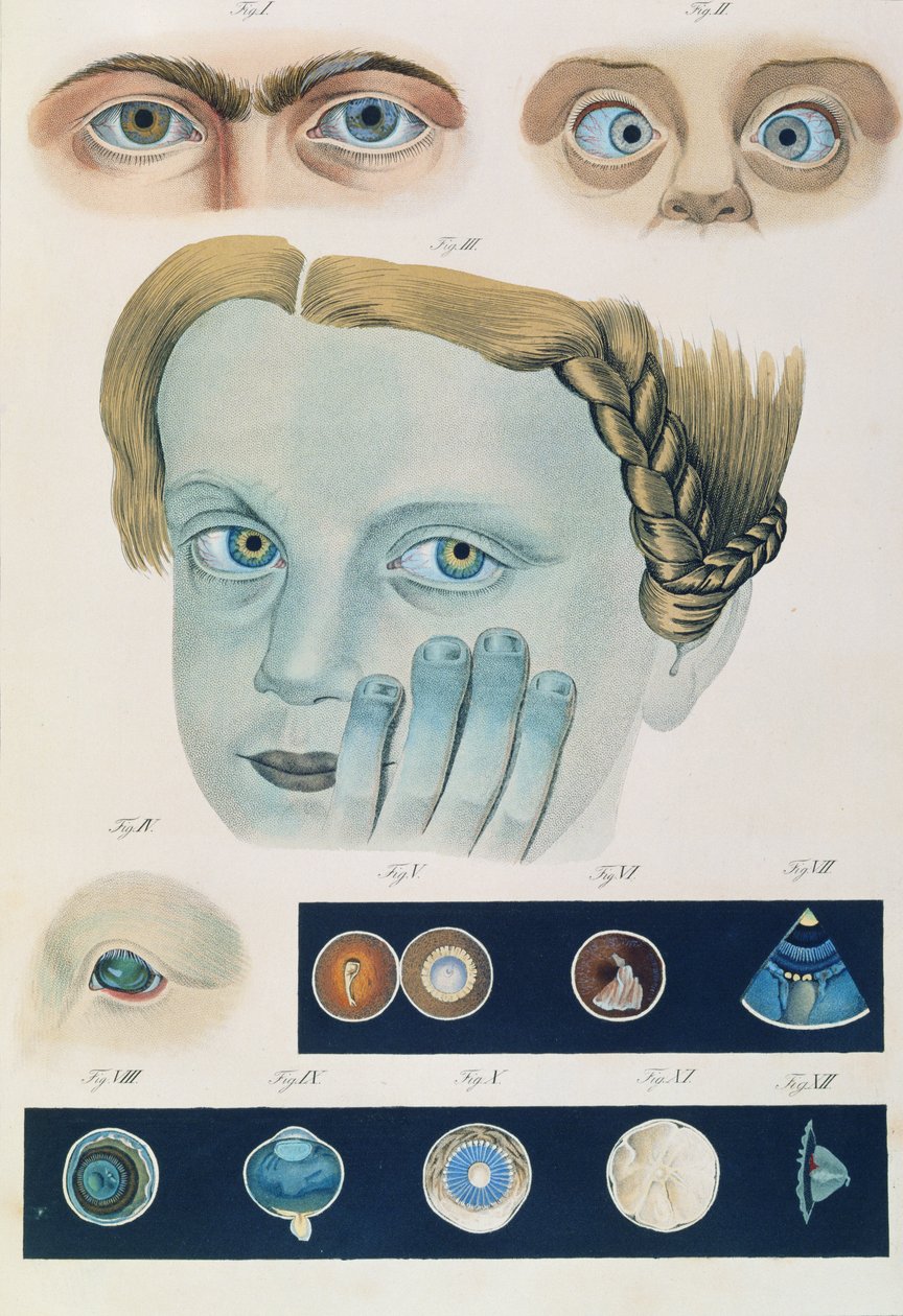Descrição das anomalias congênitas dos olhos, de Representações Clínicas de Doenças e Erros Cegantes do Olho Humano, de Friedrich August von Ammon (1799-1861) 1838 de German School