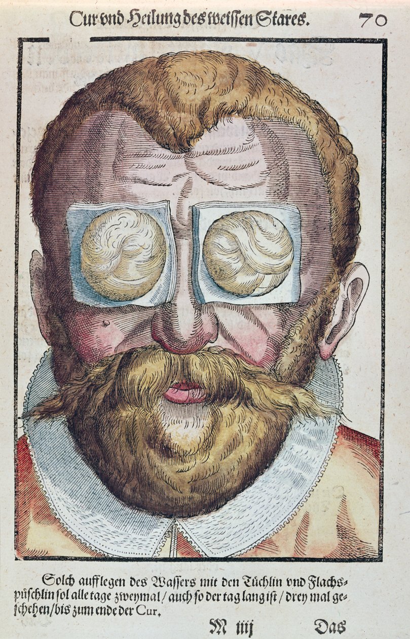 Tratar de uma condição de olho, de Ophthalmodouleia por Georg Bartisch (1535-1636) publicou em Dresden em 1583 (impressão de woodblock de cor) de German School