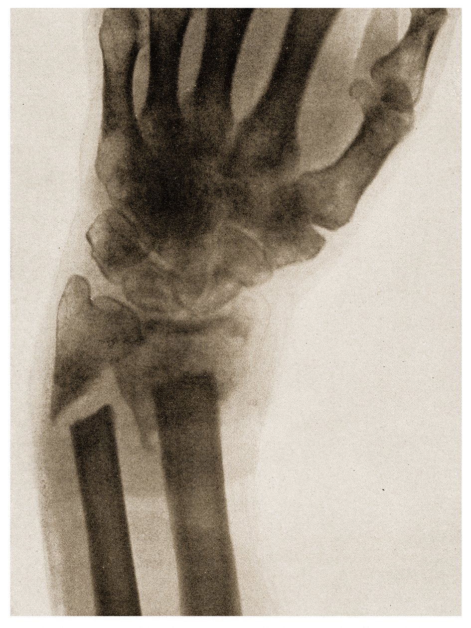 Raio X de um pulso fraturado c.1890 de German School