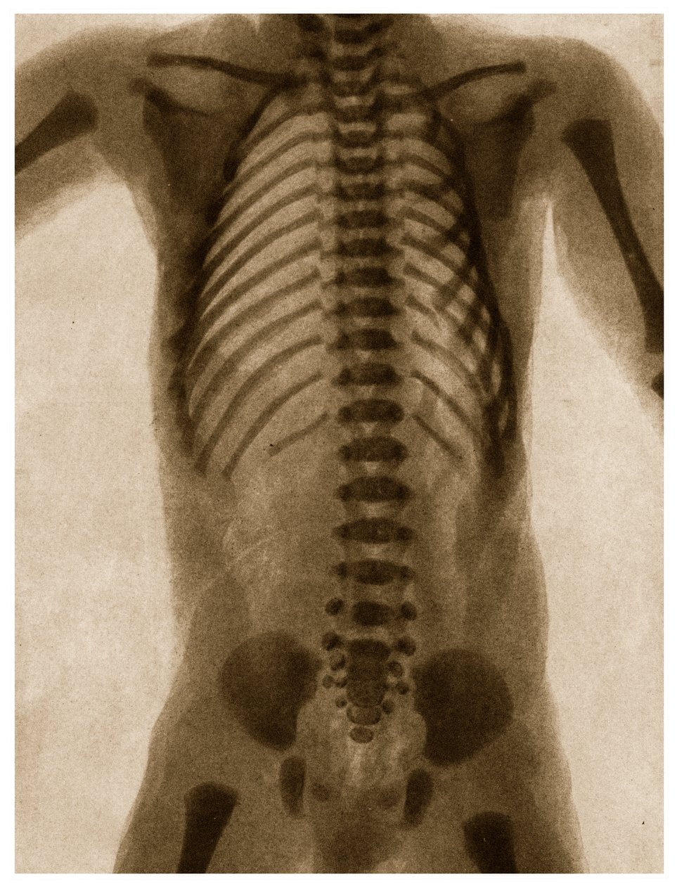 Raio X de um torso humano c.1890 de German School