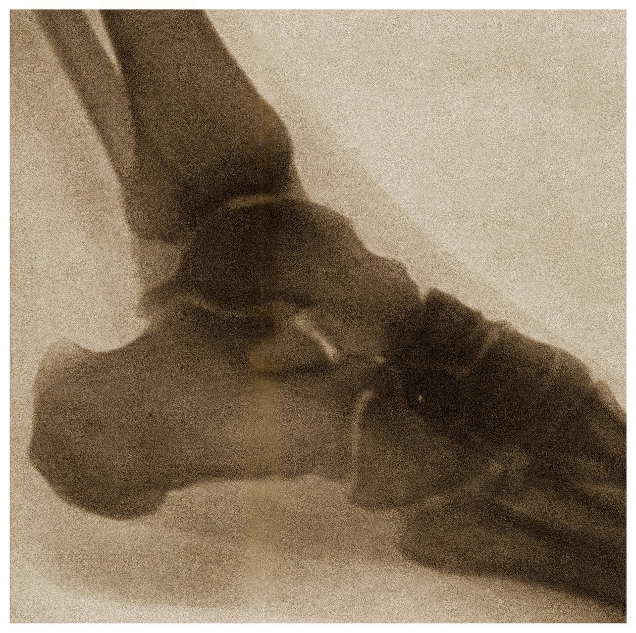 Raio X de um tornozelo c.1890 de German School