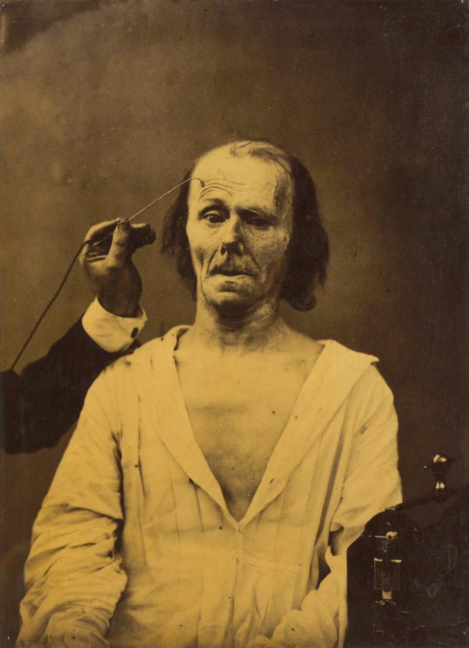 Um rosto descontraído (esquerda); Atenção profunda (direita),1854-1856, impresso em 1862 (foto) de Guillaume Benjamin Armand Duchenne de Boulogne