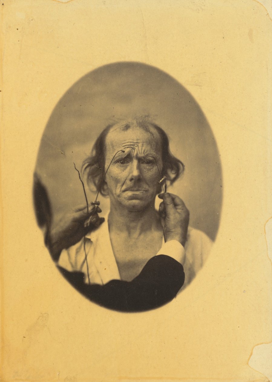 Insatisfação, pensamentos sombrios (esquerda); Reflexão (direita),1854-1856, impresso em 1862 (foto) de Guillaume Benjamin Armand Duchenne de Boulogne