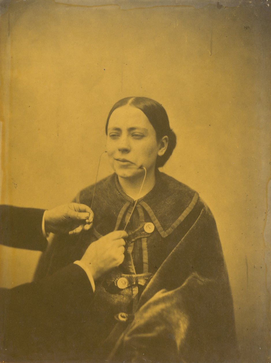 Nojo desdenhoso (esquerda); Riso desdenhoso (direita),1854-1856, impresso em 1862 (foto) de Guillaume Benjamin Armand Duchenne de Boulogne