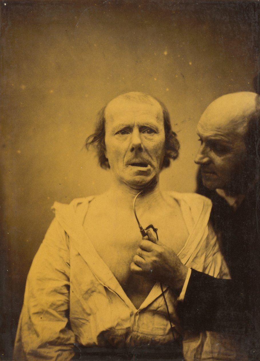 Esta contração do m. platysma só não tem expressão,1854-1856, impresso em 1862 (foto) de Guillaume Benjamin Armand Duchenne de Boulogne