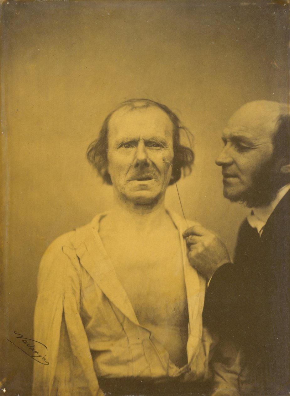 Chorando, lágrimas de piedade (esquerda); Rosto relaxado (direita),1854-1856, impresso em 1862 (foto) de Guillaume Benjamin Armand Duchenne de Boulogne