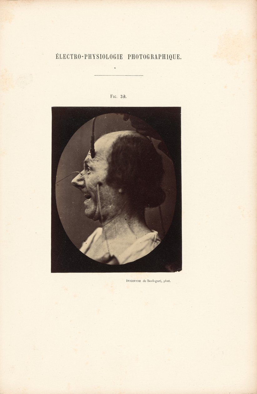 Eletrofisiologia fotográfica, Figura 39 de Guillaume Benjamin Duchenne