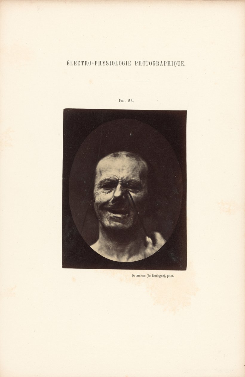 Eletrofisiologia fotográfica, Figura 53 de Guillaume Benjamin Duchenne