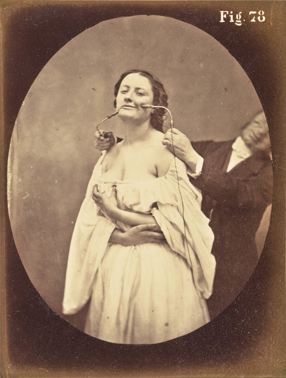 Fig. 78 de Guillaume Benjamin Duchenne