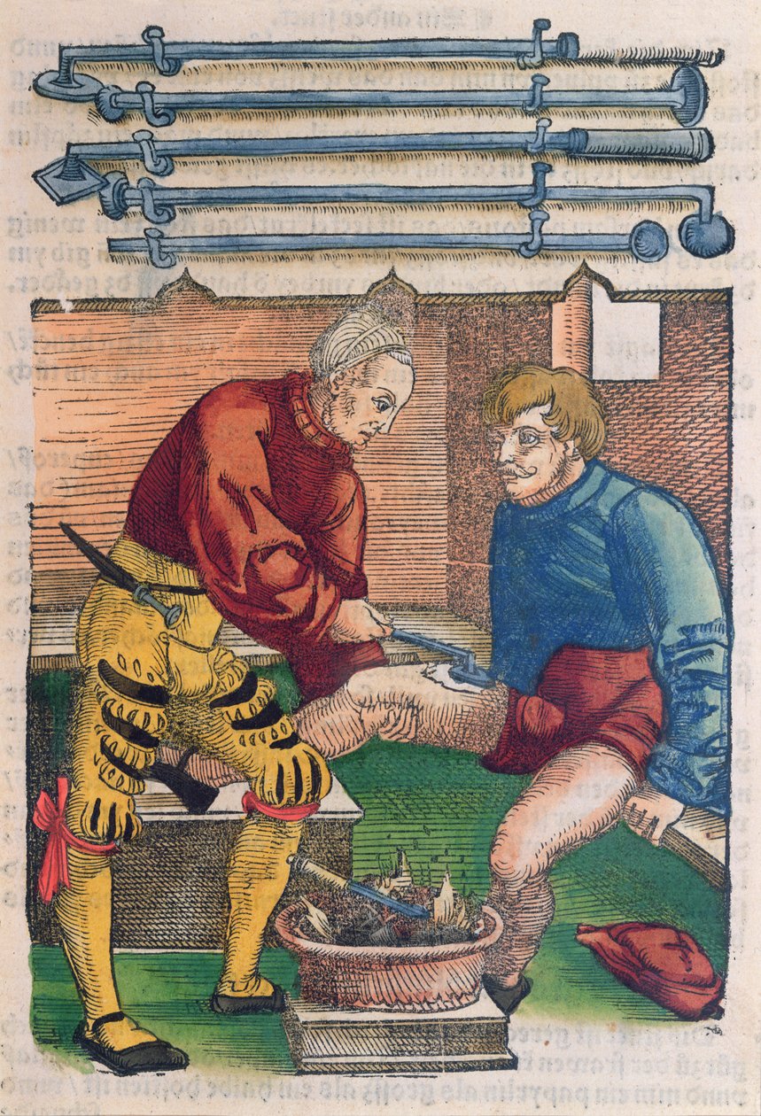 Cauterização, ilustração de &39;Feldartbuch der Wundartzney&39; por Hans von Gersdorff, c.1540 (impressão em xilogravura a cores) de Hans or Johannes Ulrich Wechtlin