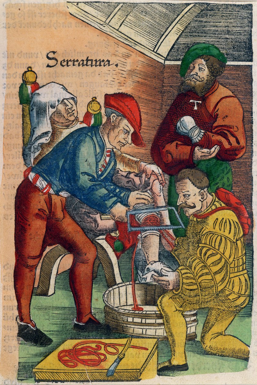 Uma amputação, ilustração de &39;Feldartbuch der Wundartzney&39; por Hans von Gersdorff, c.1540 (impressão em xilogravura a cores) de Hans or Johannes Ulrich Wechtlin