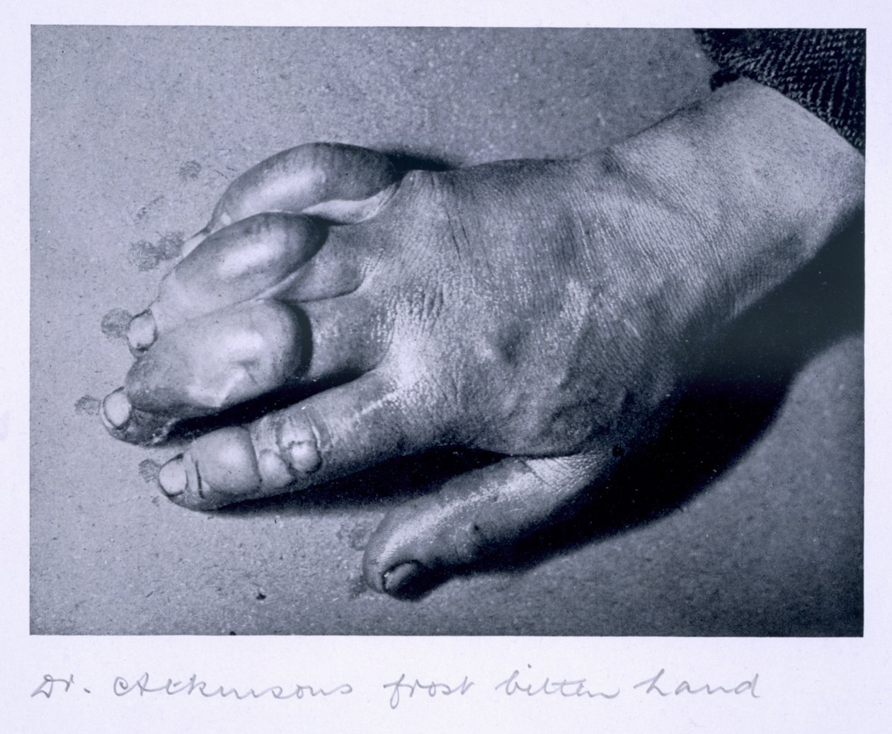 Mão gelada do Dr. Atkinson, 1911 de Herbert Ponting