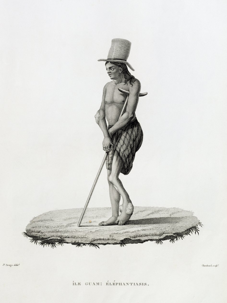 Guam: Um homem com elefantíase, de &39;Viagem ao Redor do Mundo nas Corvetas de Urania 1817-20&39; gravado por Choubard, publicado em 1825 de Jacques Etienne Victor Arago