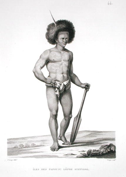 Ilhas Papua: Leprosy Victim, de 