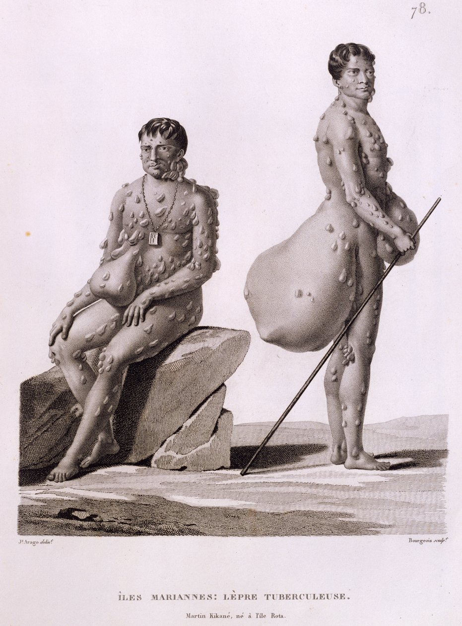 Ilhas Marianas do Norte: Dois Homens Sofrendo de Tuberculose, de &39;Viagem ao Redor do Mundo nas Corvetas de Urania 1817-20&39; gravado por Bourgeois, publicado em 1825 de Jacques Etienne Victor Arago