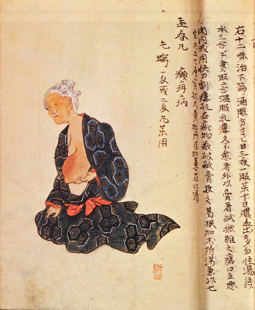 O primeiro tratamento cirúrgico do câncer de mama realizado sob anestesia geral por Seishu Hanaoka (1760-1836) em 1804 de Japanese School