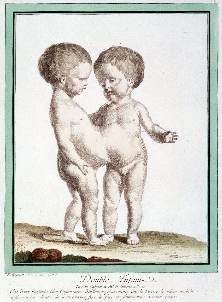 Crianças siamesas - em "Os Desvios da Natureza" de Régnault de Jean Baptiste Regnault