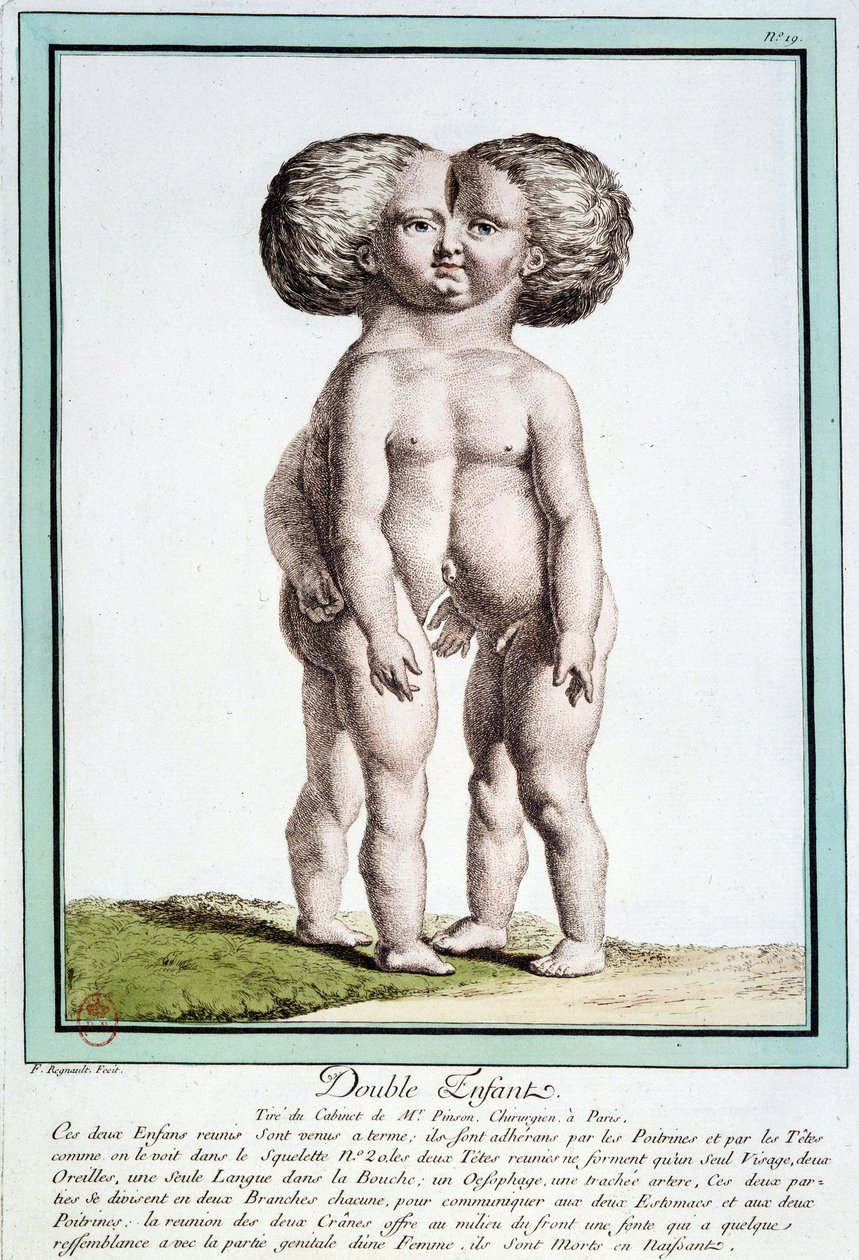 Crianças siamesas - em "Os Desvios da Natureza" de Régnault de Jean Baptiste Regnault