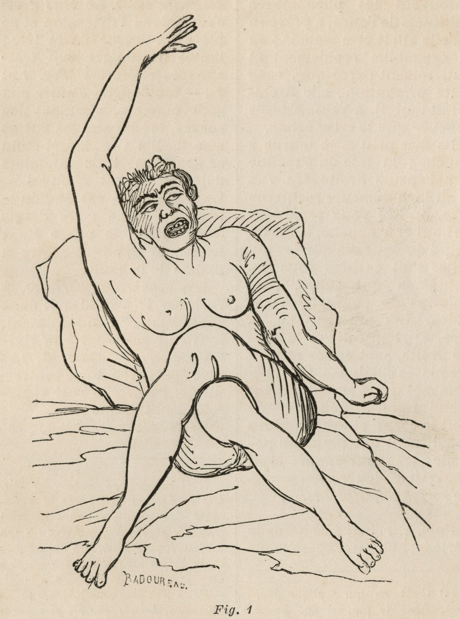 Epilepsia histérica, ataque, contorções, figo. 1 de &39;Iconografia fotográfica de La Salpetriere&39; de Bourneville e P. Regnard, Paris, 1876 de Jean Francois Badoureau
