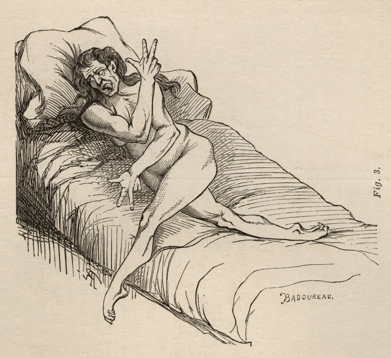 Epilepsia histérica, ataque, contorções, figo. 3 de &39;Iconografia fotográfica de La Salpetriere&39; de Bourneville e P. Regnard, Paris, 1876 de Jean Francois Badoureau