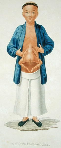 Homem chinês com um gémeo conjunto não desenvolvido preso ao abdómen, ilustração de um livro de viagens francês, gravado por M. Legrand (gravura a cores) de Jean Gabriel (after) Pretre