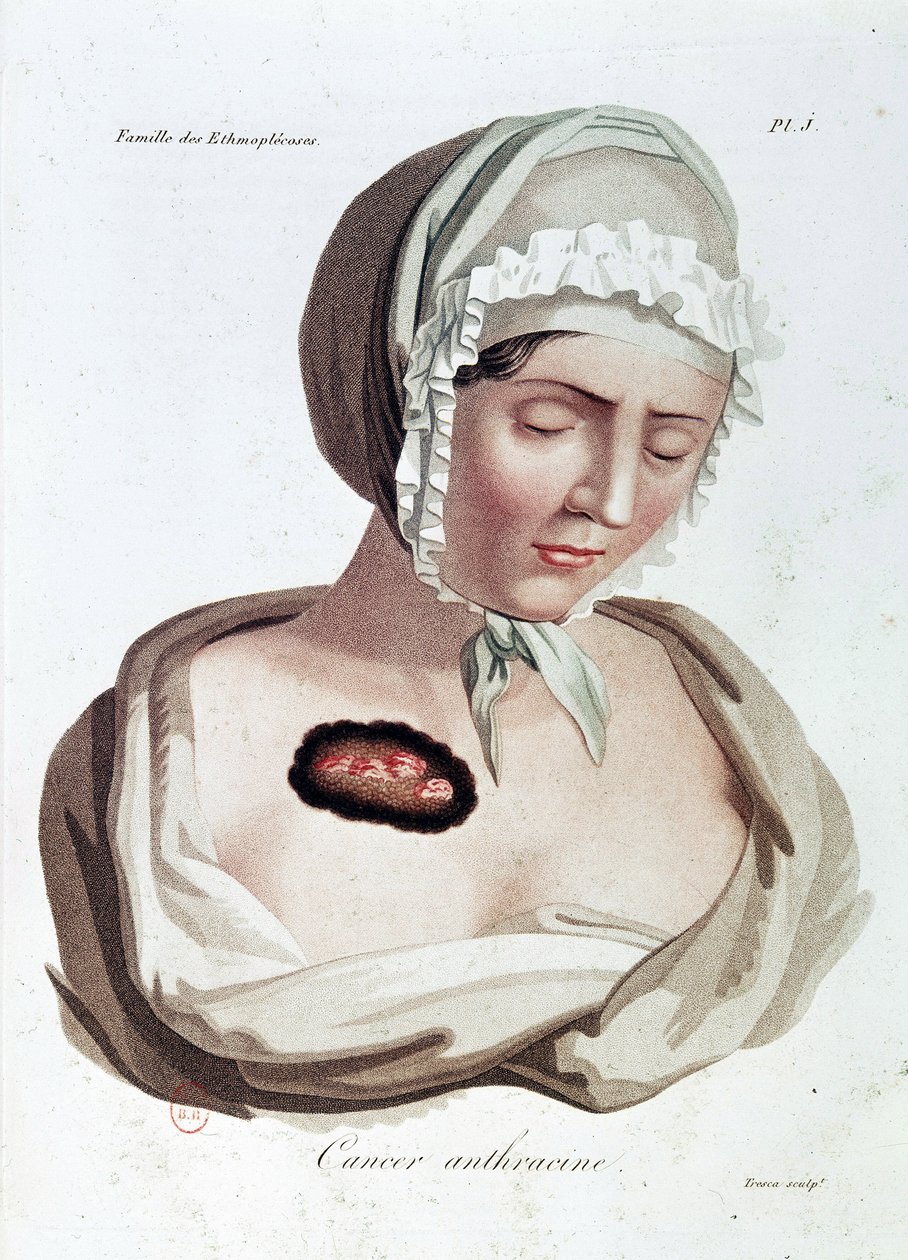 Anthracine Cancer - Alibert, B.N. de Jean Louis Alibert