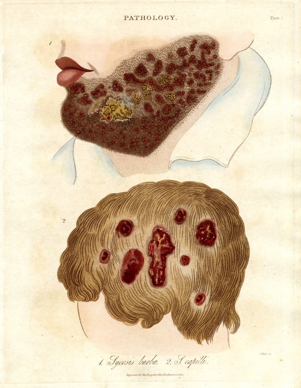 Ilustração patológica de Sycosis barbae e Sycosis capilli de John Pass