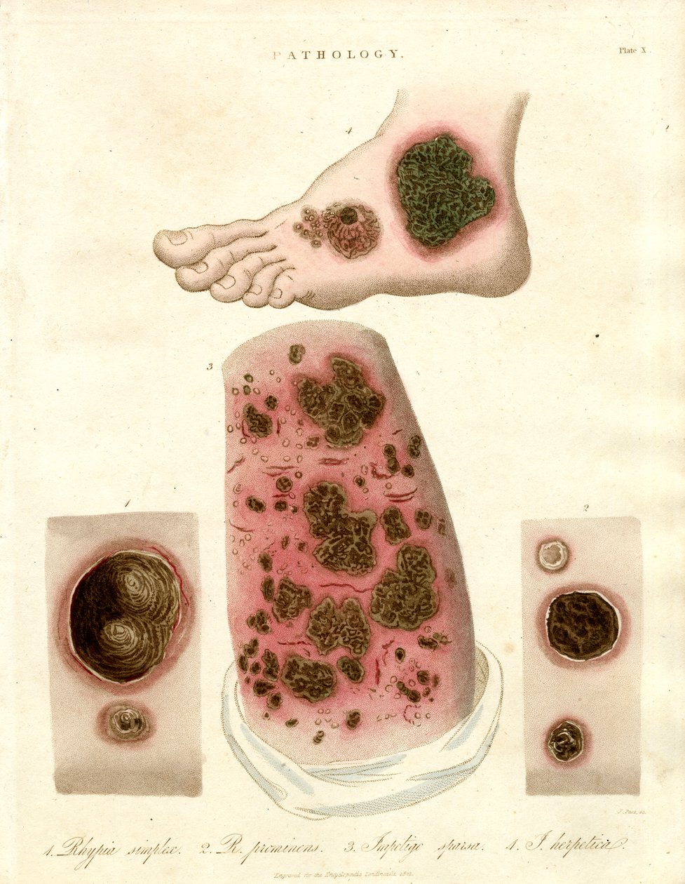 Doenças patológicas da pele - Pitiríase, Impetigo e Sífilis de John Pass