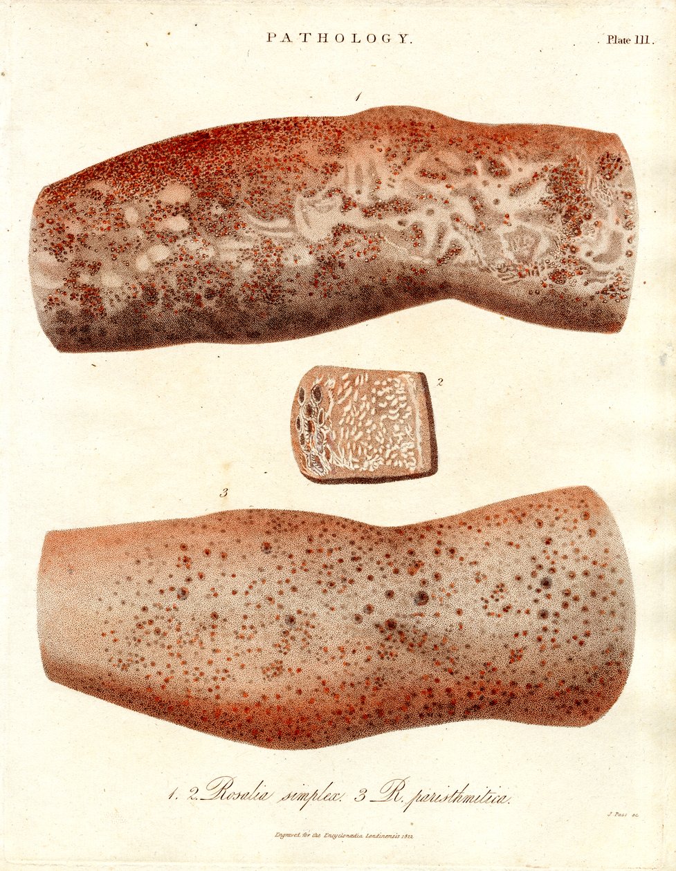 Erupções cutâneas - Roseola simplex e Roseola paristhmitica de John Pass