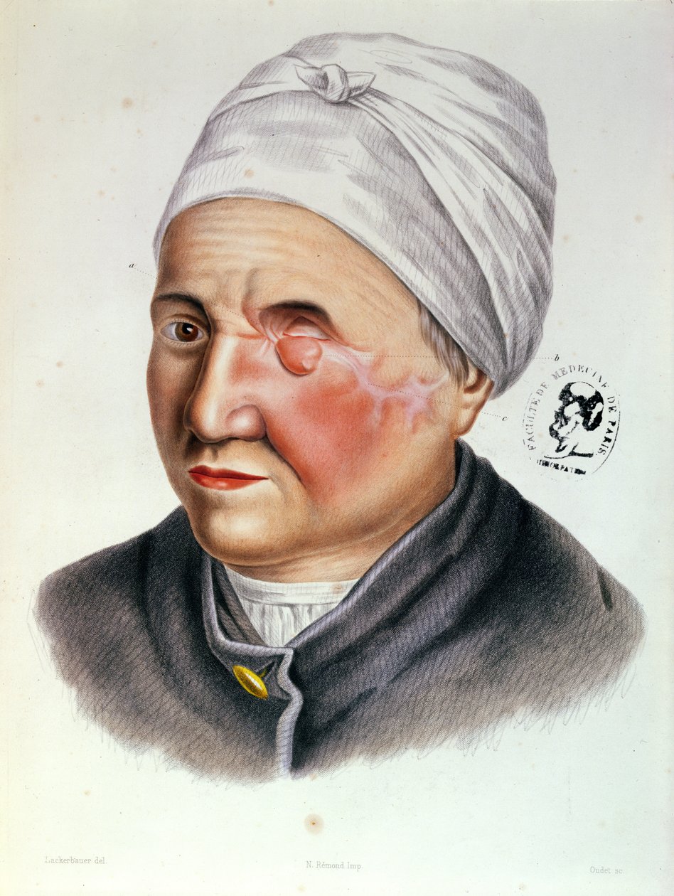Ilustração do Tratado de Cirurgia Plástica de Antoine Jobert de Lamballe (1799-1867) Paris, 1849 de Lackerbauer