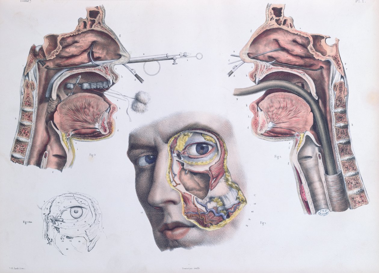 Operação Nasal, placa de &39;Tratado Completo da Anatomia do Homem&39; de Jean-Baptiste Marc Bourgery (1797-1849) 1866-67 de Nicolas Henri Jacob