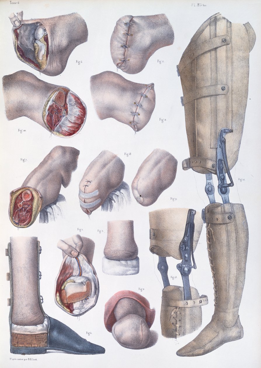 Amputações e próteses, placa do "Tratado Completo sobre a Anatomia do Homem", de Jean-Baptiste Marc Bourgery (1797-1849) 1866-67 de Nicolas Henri Jacob