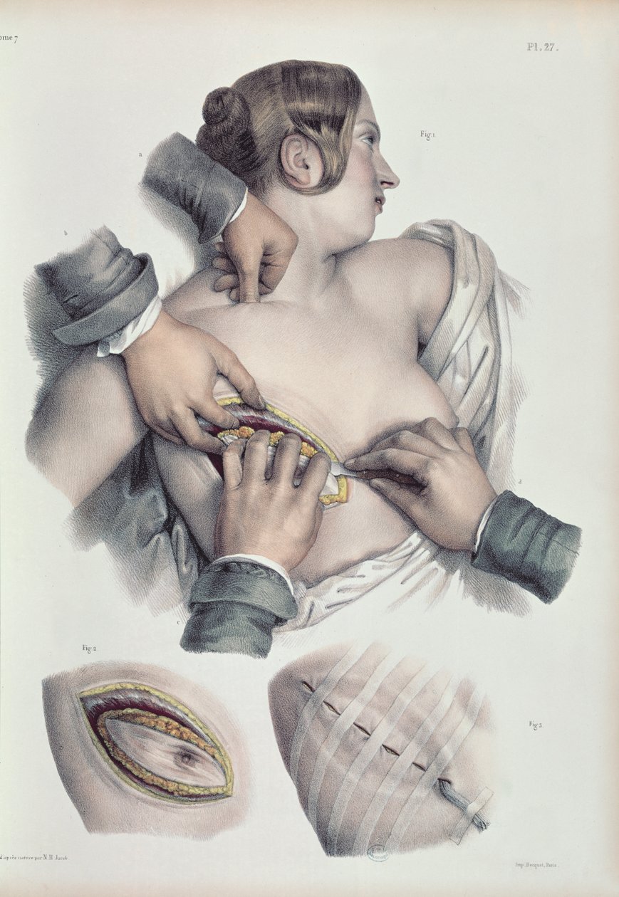 Operando em um tumor canceroso, de "Tratado Completo sobre a Anatomia do Homem", de Jean-Baptiste Marc Bourgery (1797-1849) 1866-67 de Nicolas Henri Jacob