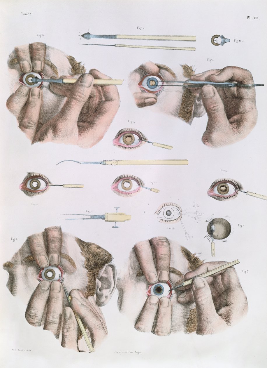 Operação em um olho, prato do "Tratado Completo sobre a Anatomia do Homem", de Jean-Baptiste Marc Bourgery (1797-1849) 1866-67 de Nicolas Henri Jacob