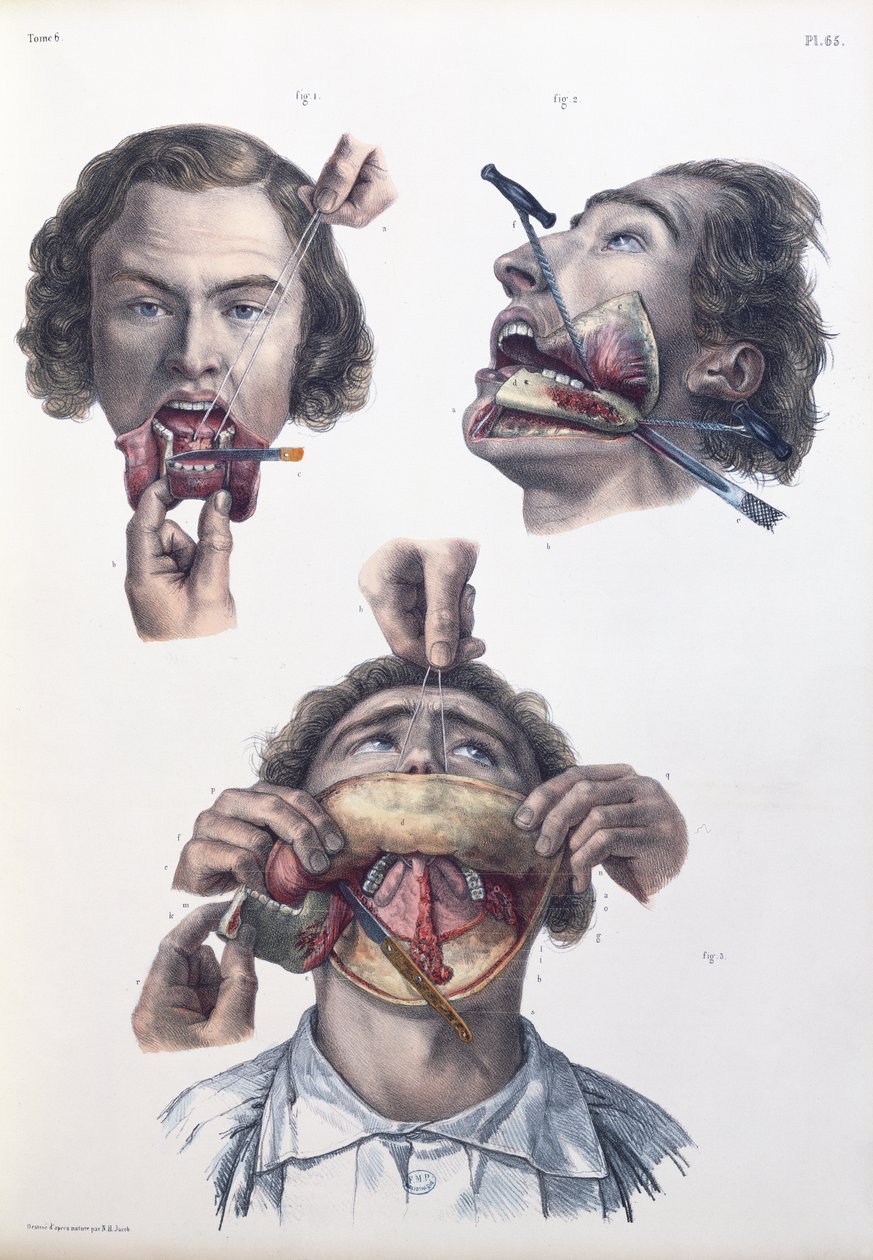 Operação no maxilar inferior, placa de "Traço Completo da Anatomia do Homem" por Jean-Baptiste Marc Bourgery (1797-1849) 1866-67 de Nicolas Henri Jacob